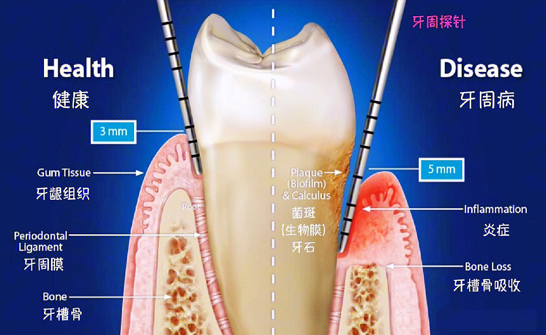 什么是牙周袋?- 健康160