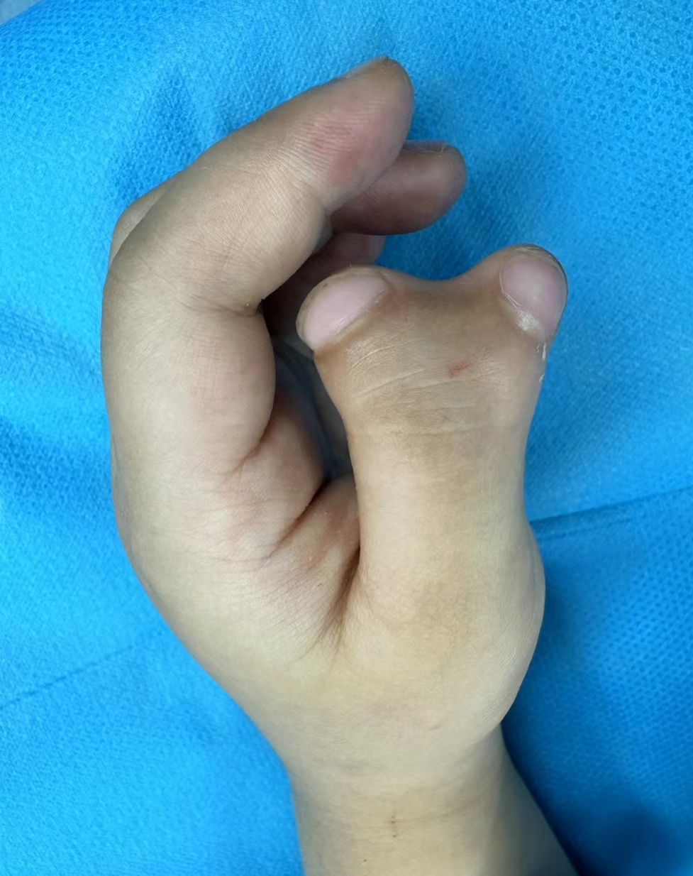 真的多指多福吗,别再纠结多指畸形治不治了!- 健康160