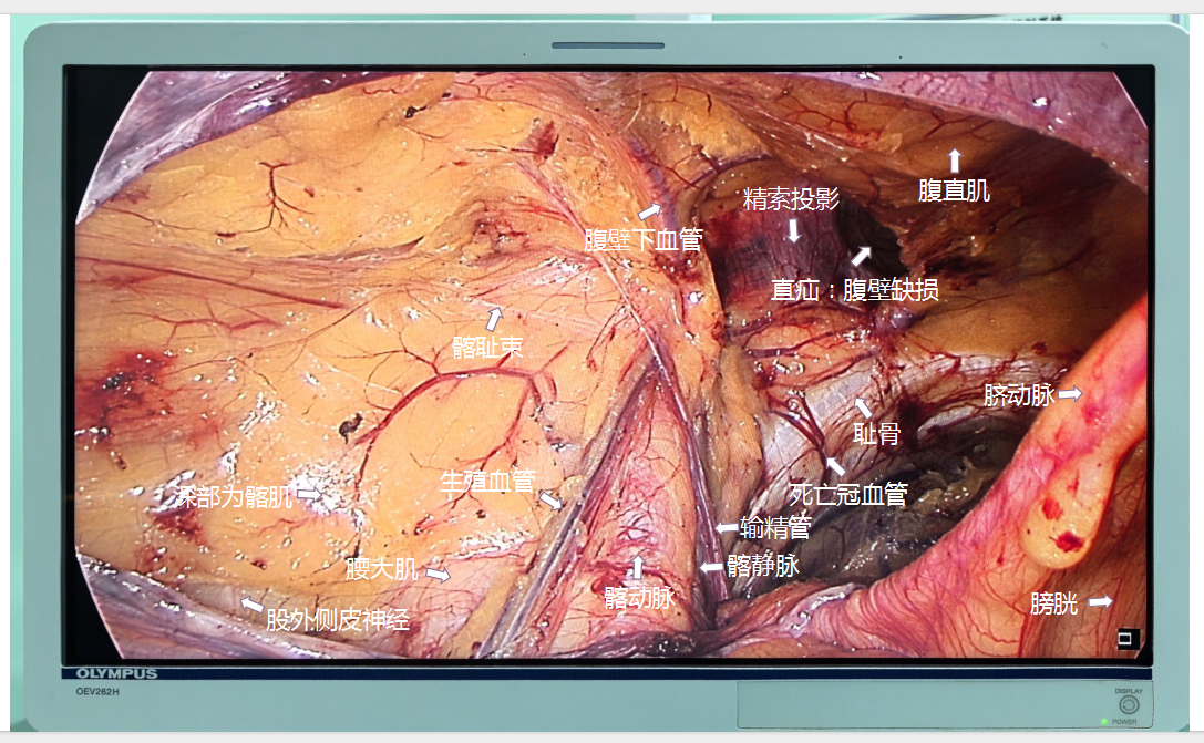 腹腔镜下腹股沟疝局部解剖