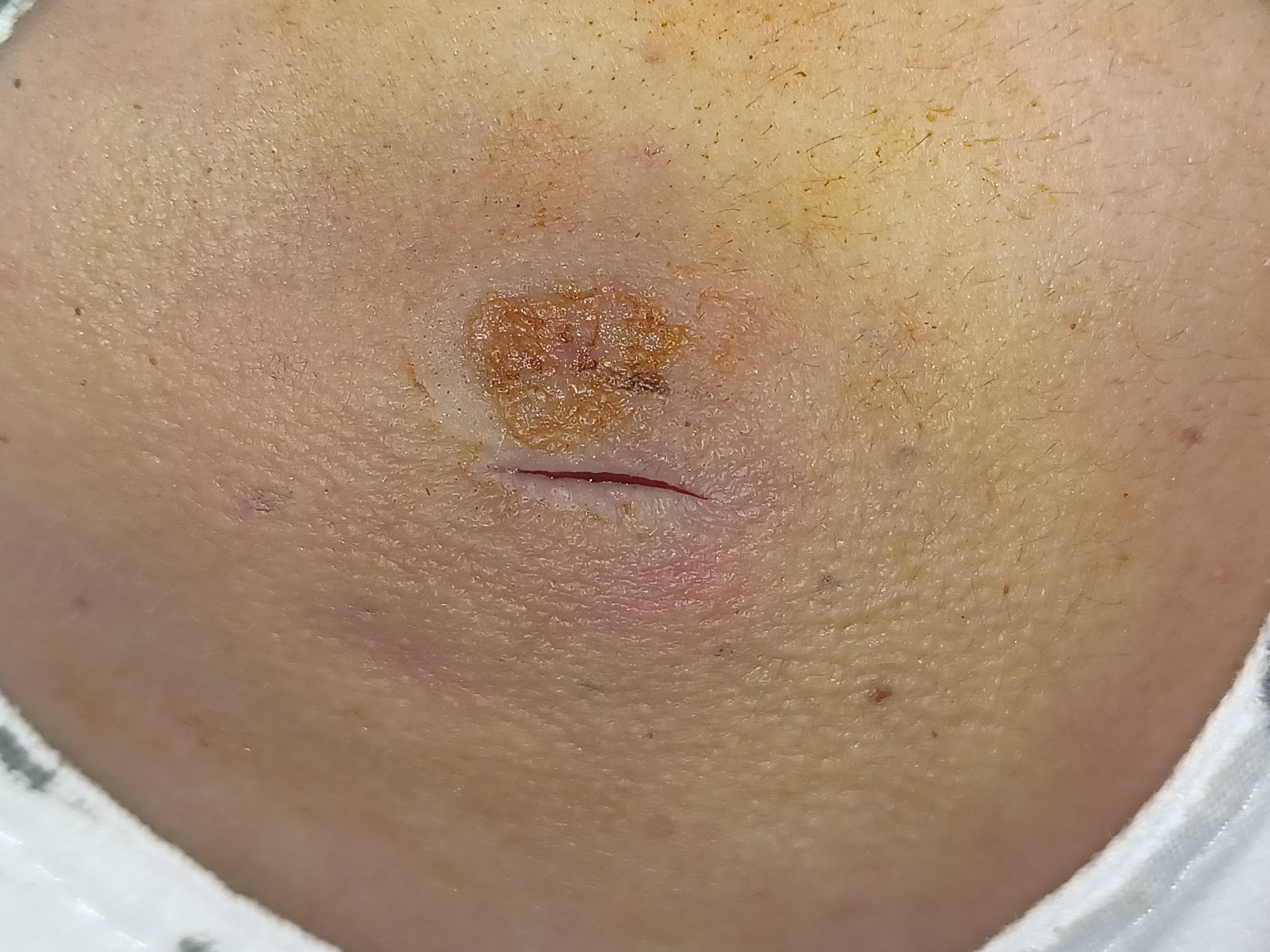 脓肿切开引流术