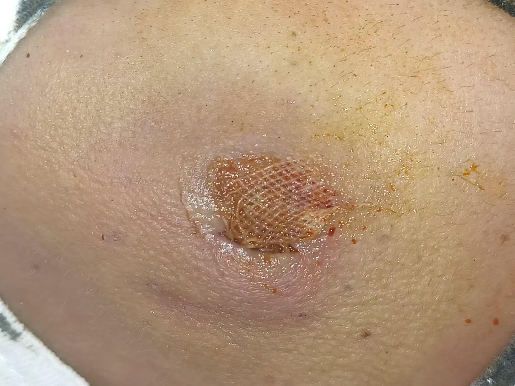 脓肿切开引流术