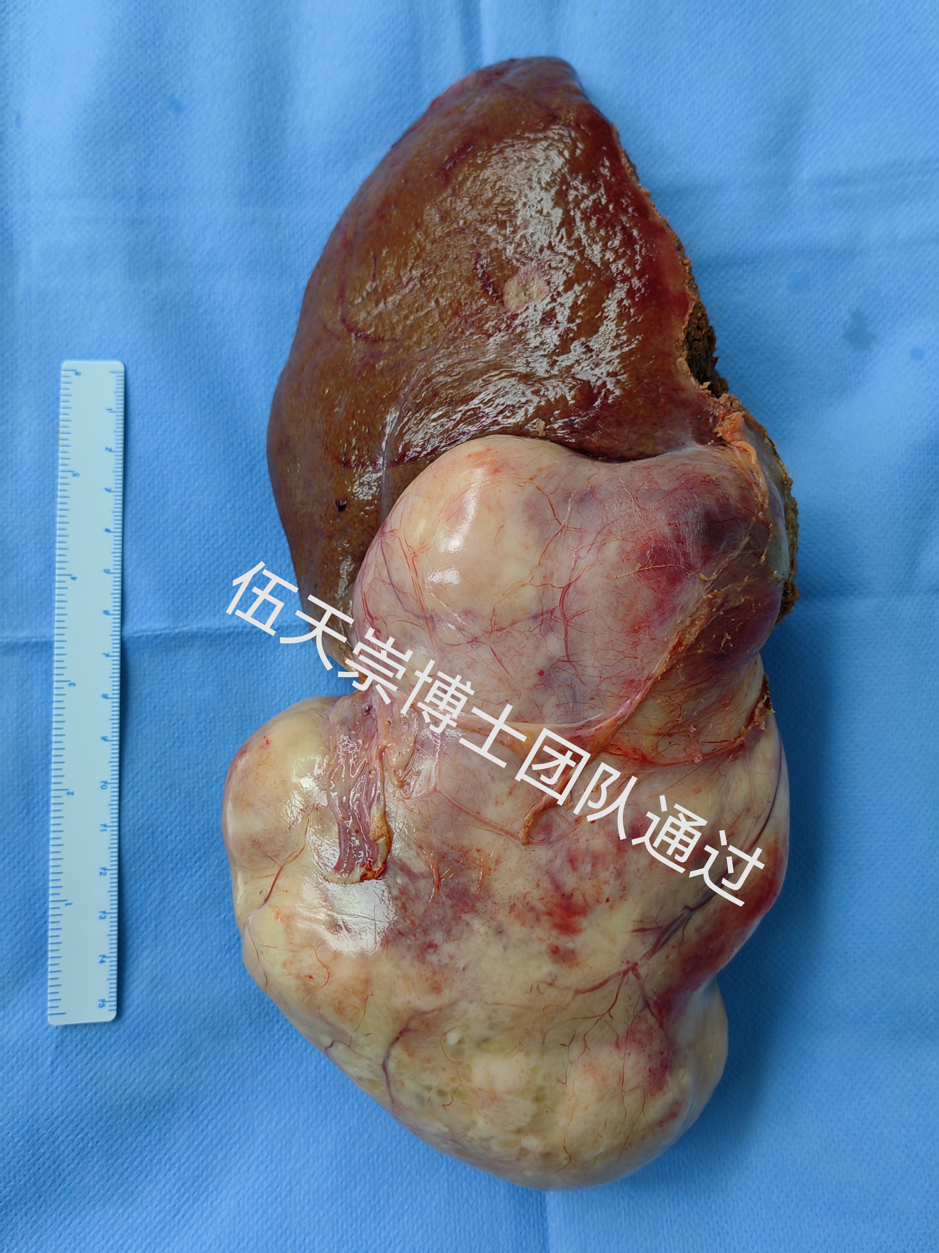 数字智能化技术微创手术切除肝巨大肿瘤