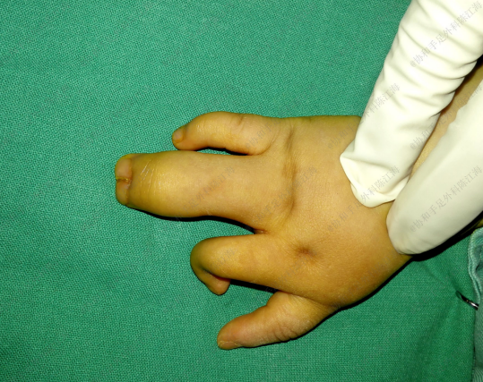 家里宝宝两根手指并在一起,手术不植皮可以吗?