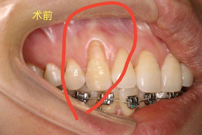 膜龈手术前后，牙龈退缩治疗