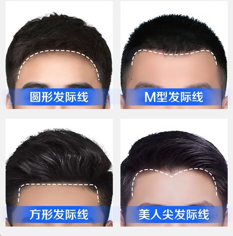男生植发的主要几种发际线形状- 健康160
