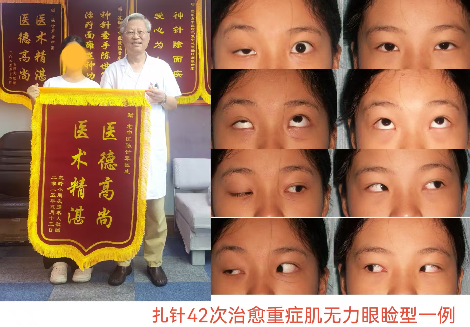扎针治愈重症肌无力眼睑型一例