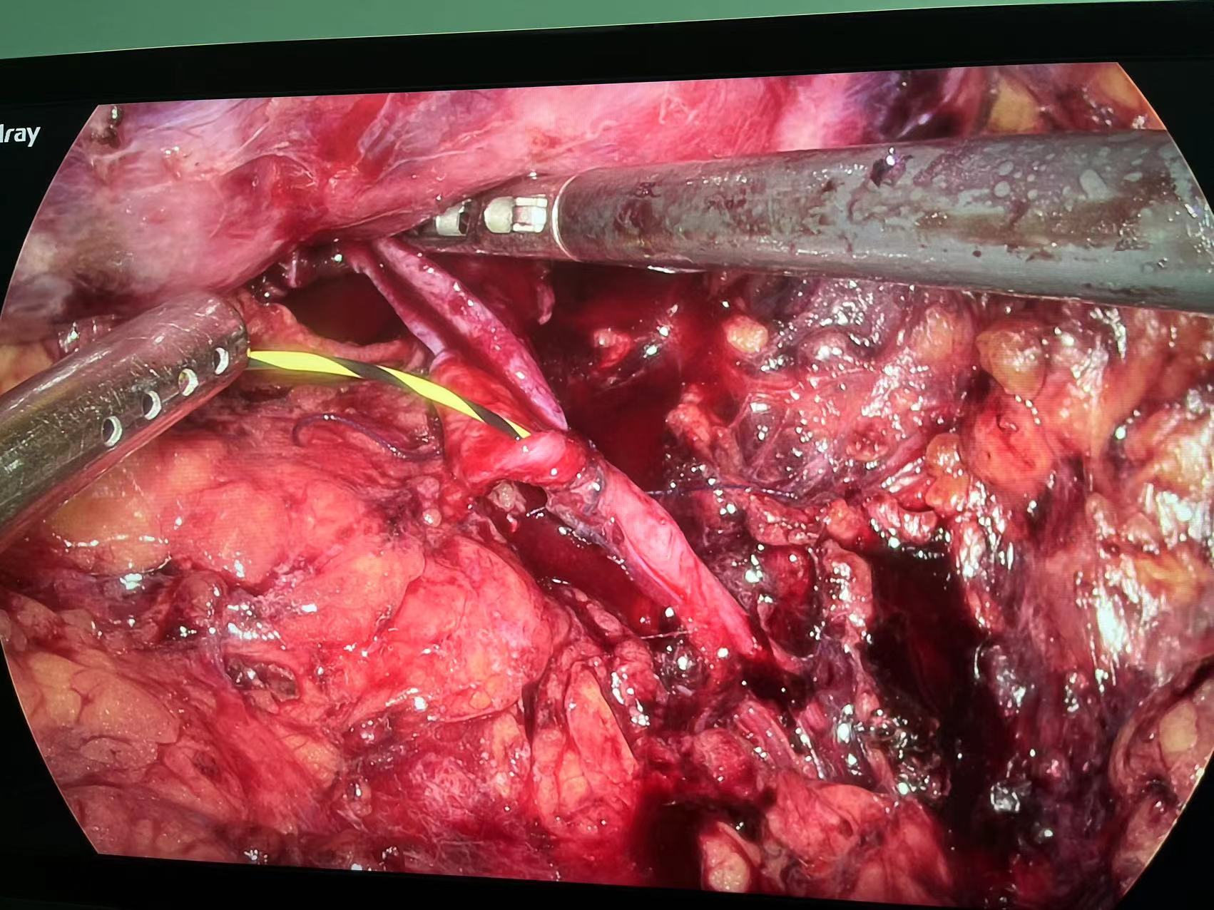 微创手术解决精细手术难题