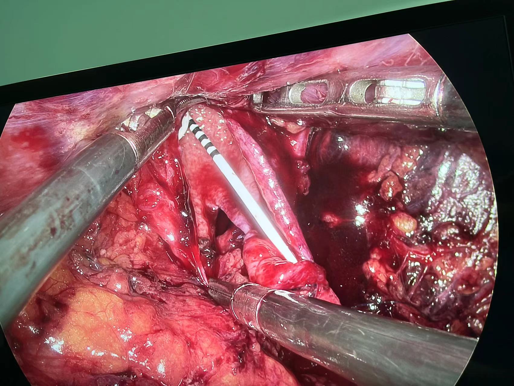 微创手术解决精细手术难题