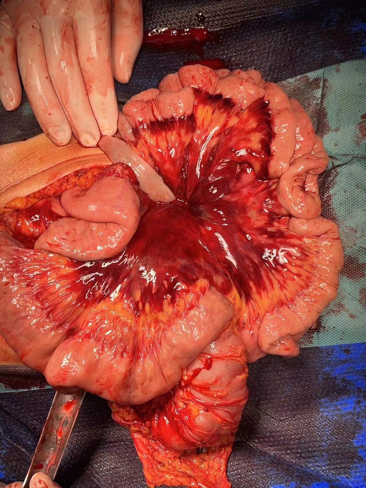 急诊抢救腹部外伤导致胰腺钩突破裂出血并导致腹膜后巨大血肿