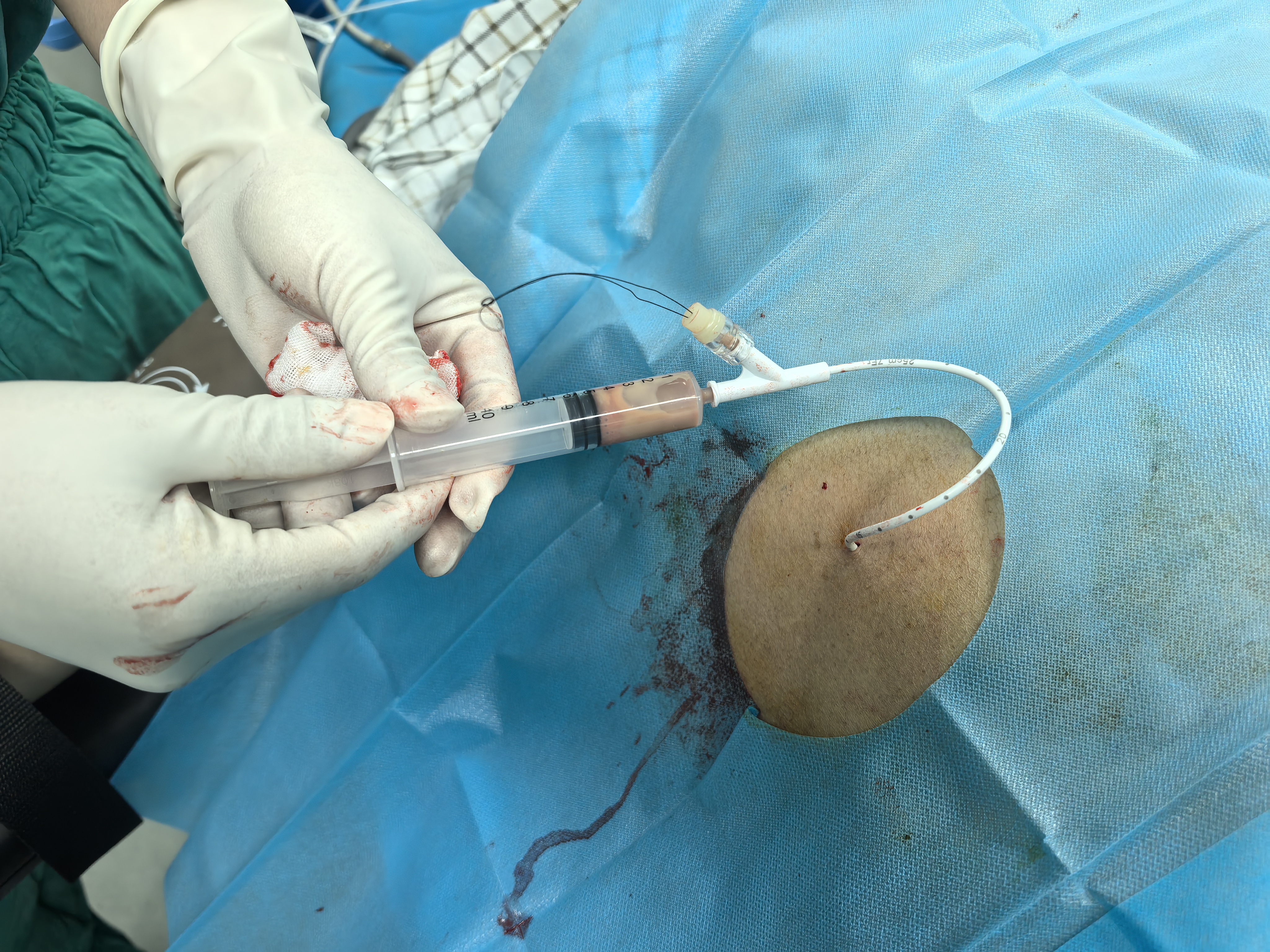 不同部位的脓肿